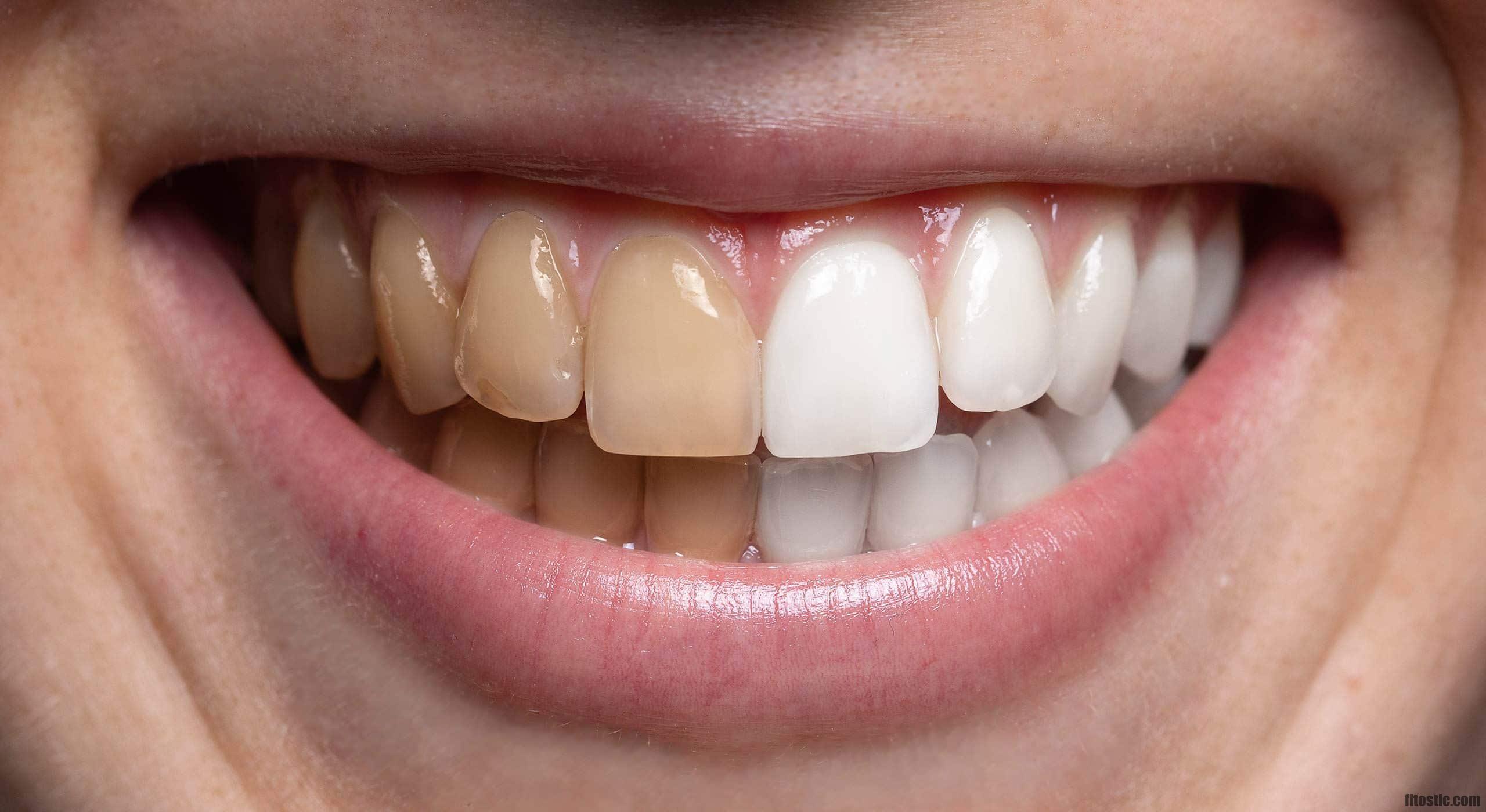 Comment se passe un détartrage chez le dentiste ? Sport, Mode, Beauté Comment se passe un détartrage chez le dentiste ? Sport, Mode, Beauté