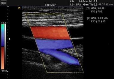 Comment se passe un écho Doppler ?