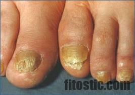 Comment soigner des ongles de pieds épais ?