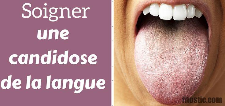 Comment soigner la candidose œsophagienne ?