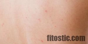 Comment soigner l'acné rosacée naturellement ?