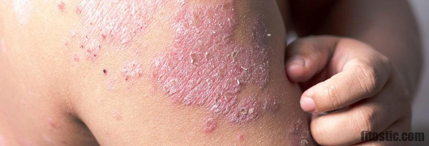 Comment soigner le psoriasis sur les doigts ?