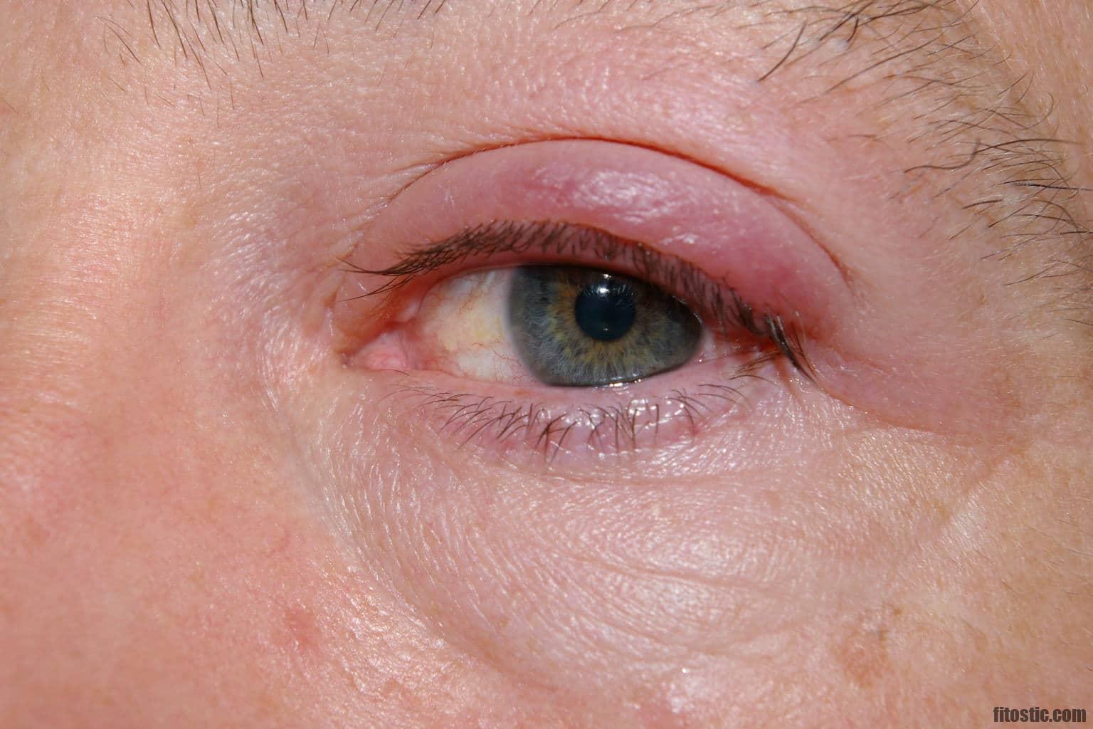 Comment soigner un chalazion interne ?