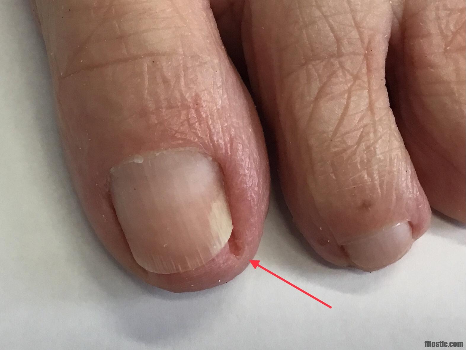 Comment soigner un ongle blanc ?