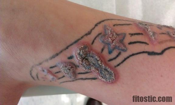 Comment soigner une allergie au tatouage ?