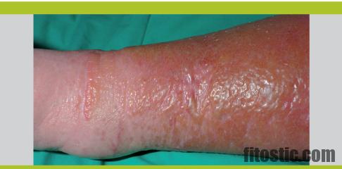 Comment soigner une dermite ocre sur les jambes ?