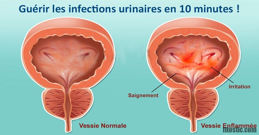 Comment soigner une infection urinaire en 10 minutes ?