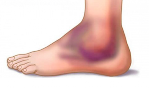 Comment soigner une inflammation du duodénum ?  Fitostic.com  Sport