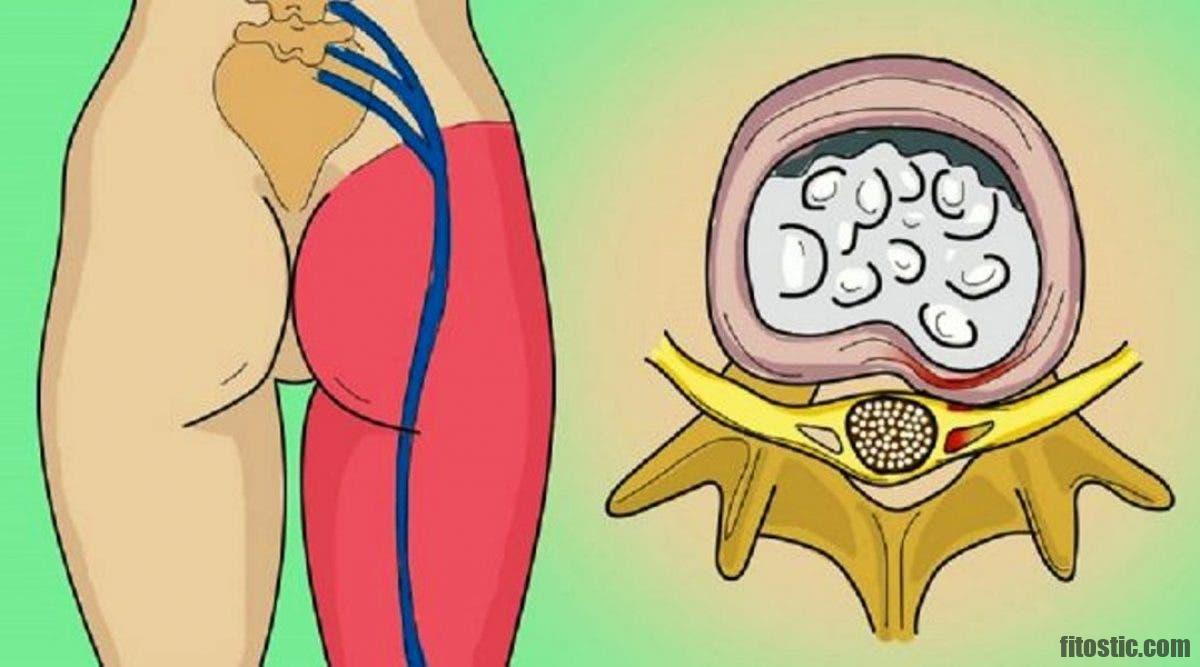 Comment soulager les douleurs d'une sciatique en 60 secondes ?