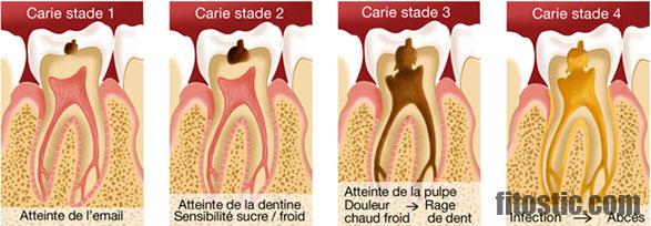 Comment soulager un mal de dent après dévitalisation ?