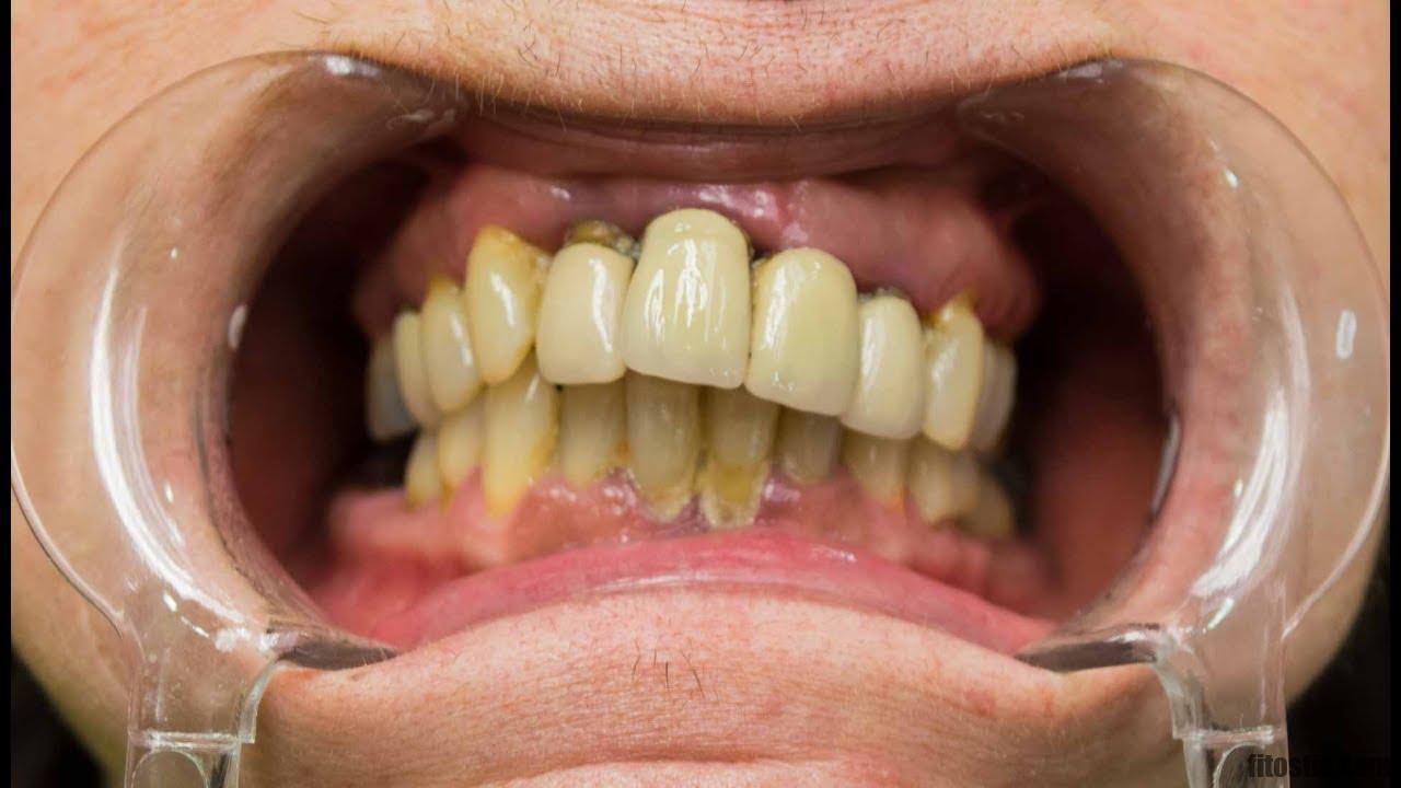 Comment stopper un déchaussement dentaire ?