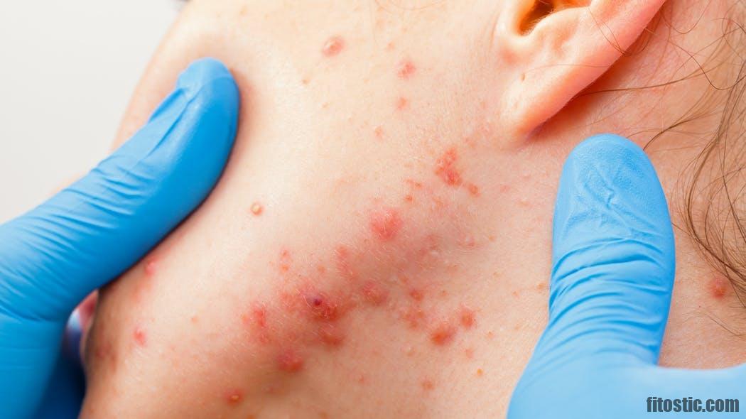 Comment traiter l'acné de l'adolescent ?