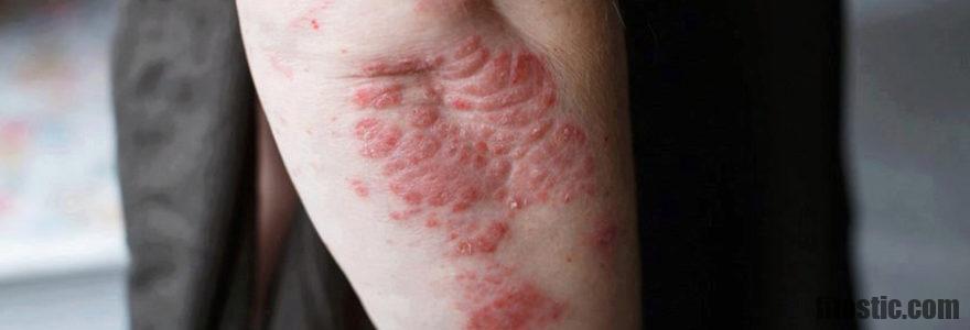 Comment traiter le psoriasis du visage ?