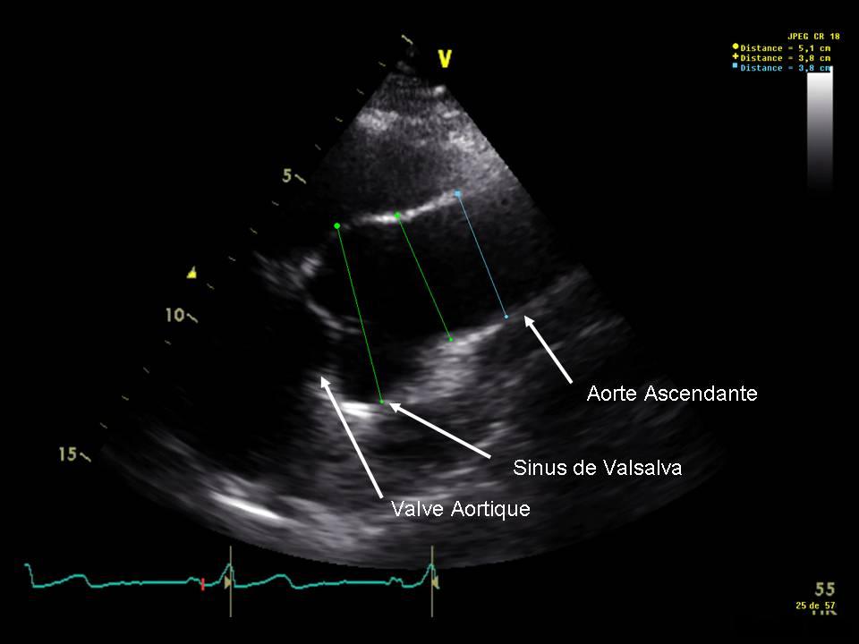 Comment vivre avec une fuite aortique ?