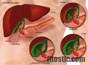 Comment vivre sans la vésicule biliaire ?