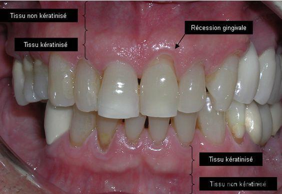 Comment voir le doublement des gencives ?
