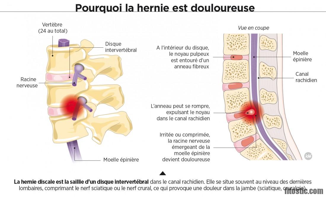 Est-ce grave de faire une biopsie ?