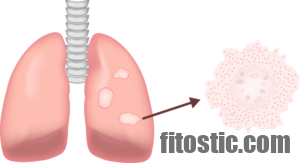 Est-ce que la fibrose pulmonaire est contagieuse ?