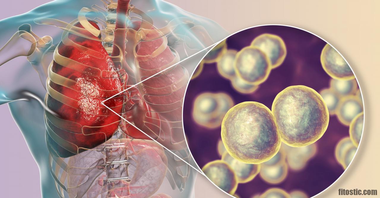 Est-ce que la pneumonie est mortel ?