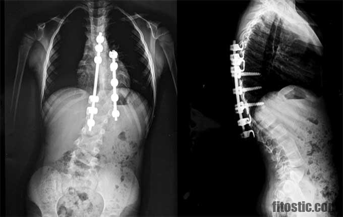 Est-ce que la scoliose est grave ?