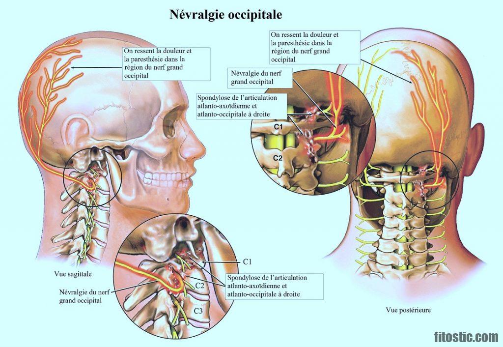 Est-ce que l'arthrose cervicale peut donner des maux de tête ?