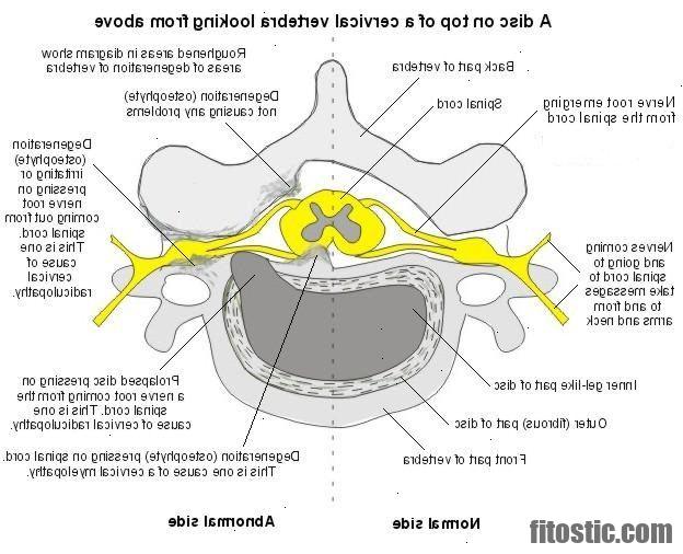 Est-ce que l'arthrose cervicale peut donner des vertiges ?