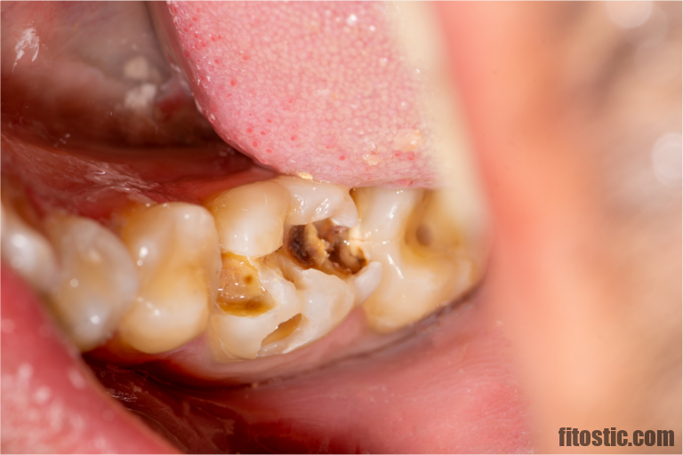 Est-ce que le détartrage Dechausse les dents ?