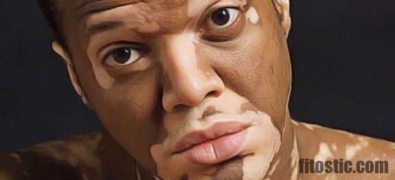 Est-ce que le vitiligo peut disparaître ?