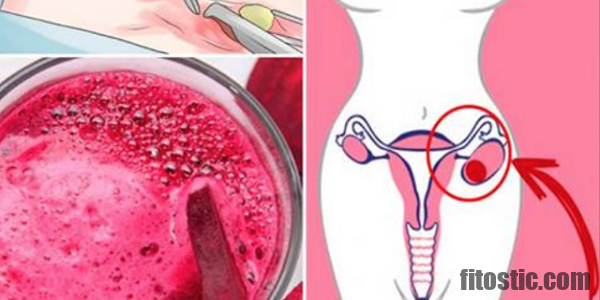 Est-ce que les ovaires polykystiques Peuvent-ils disparaître ?