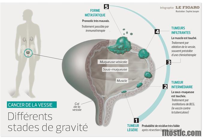 Est-ce que les polypes de la vessie sont toujours cancereux ?