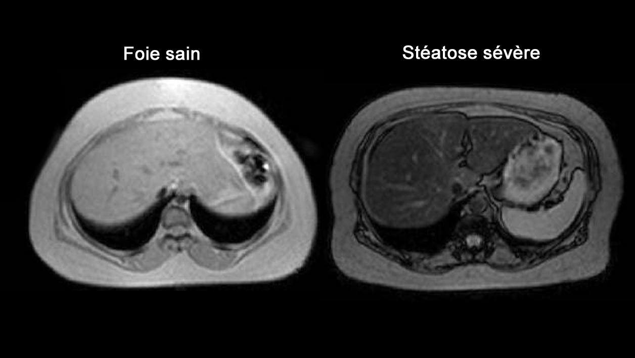 Est-ce que un fibrome peut se transformer en cancer ?