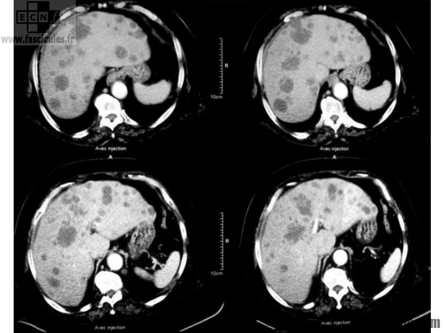 Est-ce qu'un pneumothorax est grave ?