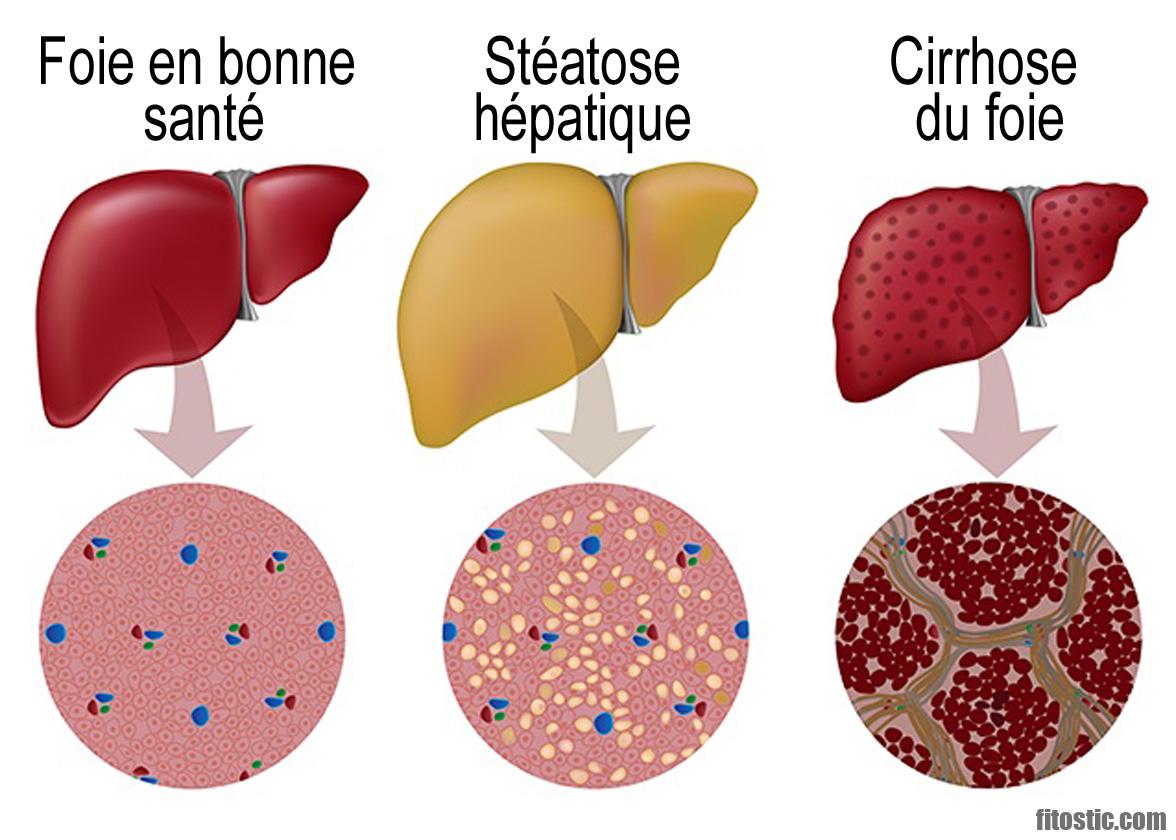 Est-ce qu'une cirrhose du foie se soigne ?