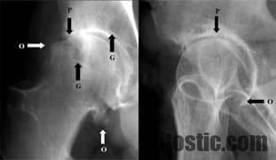 Où se situe douleur arthrose hanche ?