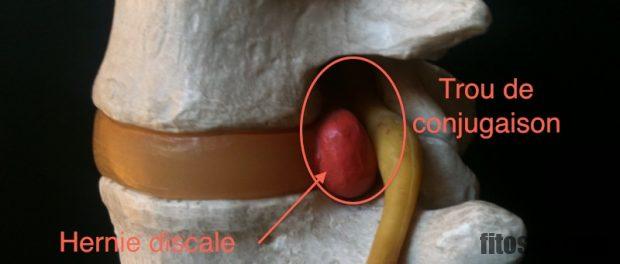 Où se situe la douleur d'une hernie discale ?