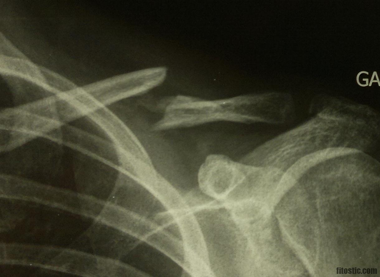 Pourquoi glacer une fracture ?