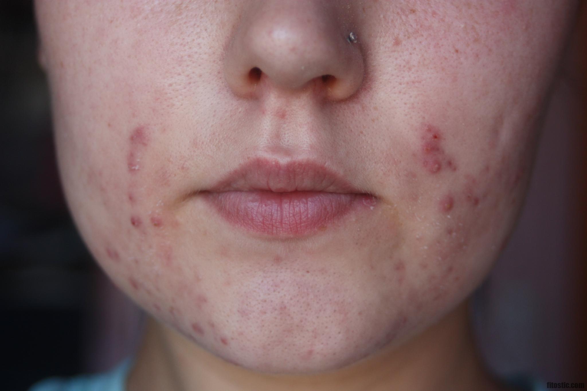 Pourquoi j'ai une poussée d'acné ?