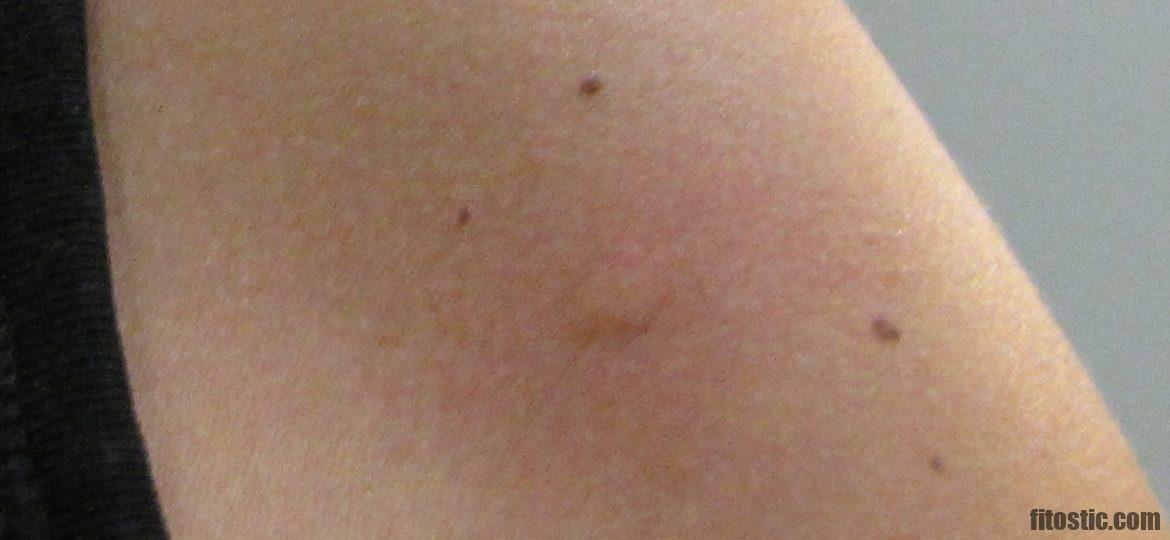 Pourquoi ma peau attire les moustiques ?