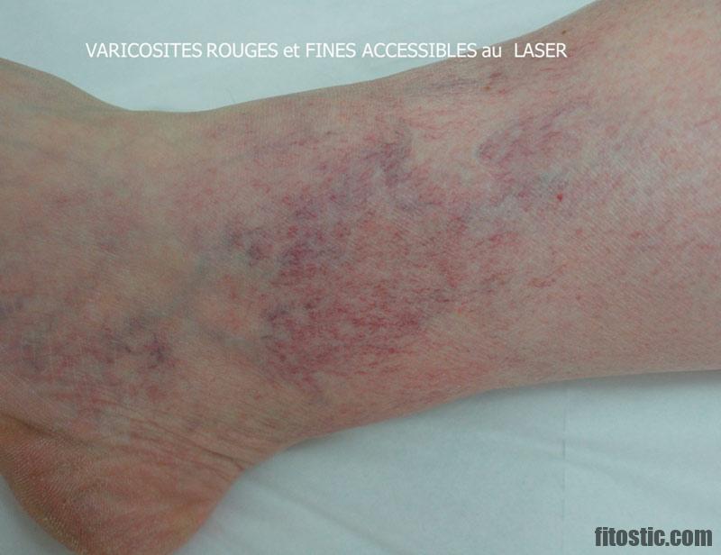 Pourquoi mes jambes sont rouges ? - Fitostic.com - Sport, Mode, Beauté ...