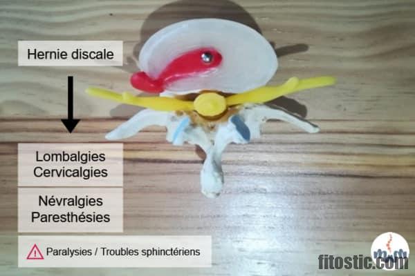 Pourquoi une hernie ne se Resorbe pas ?