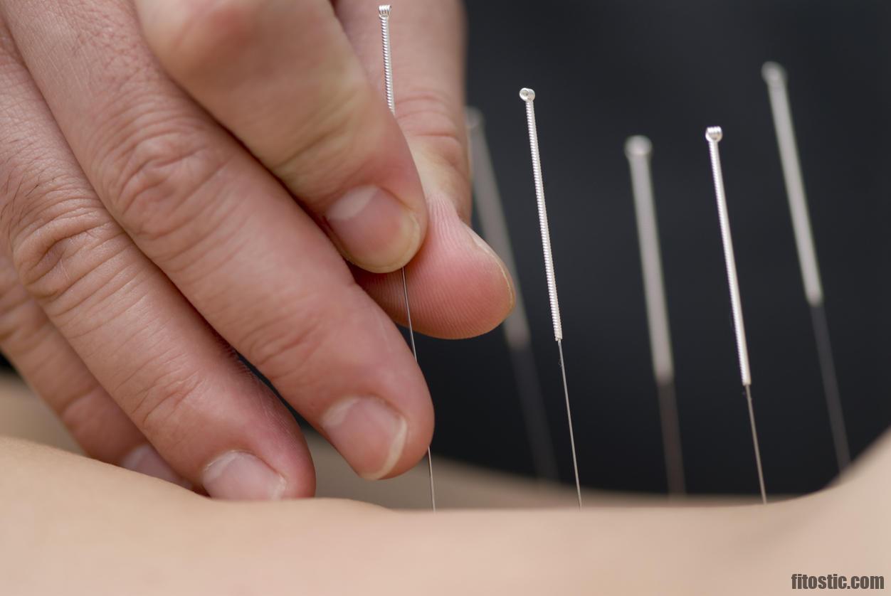 Quand faire acupuncture pour declencher accouchement ?