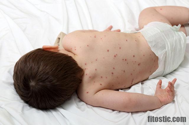 Quand la varicelle n'est plus contagieuse ?