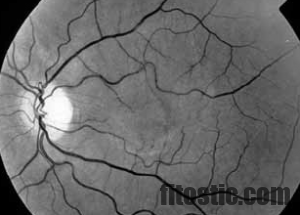 Quand opérer une membrane Epiretinienne ?