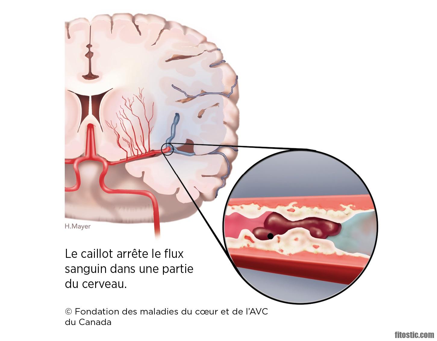 Quand survient un infarctus ?