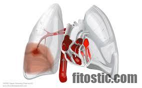 Quel cancer peut provoquer une embolie pulmonaire ?