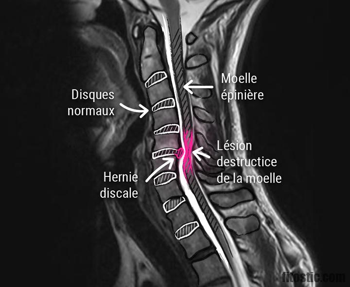 Quel médecin consulter pour une névralgie cervico brachiale ?