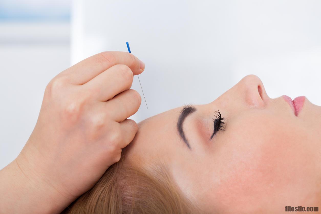 Quel point d'acupuncture pour la migraine ?