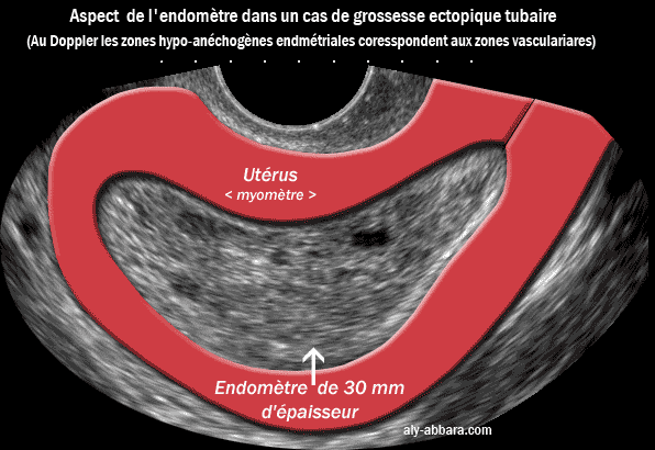 Quel sont les signes de grossesse d'une semaine ?