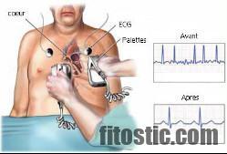 Quelle anesthésie pour une cardioversion ?