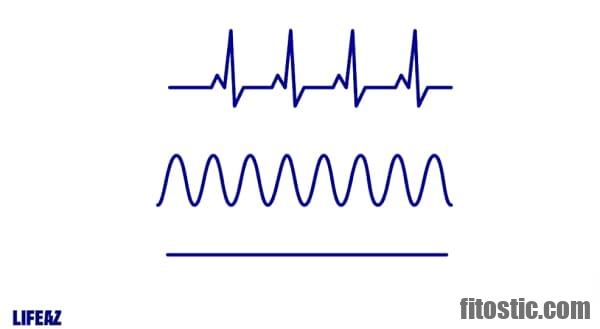 Quelle est la différence entre une crise cardiaque et un infarctus ?